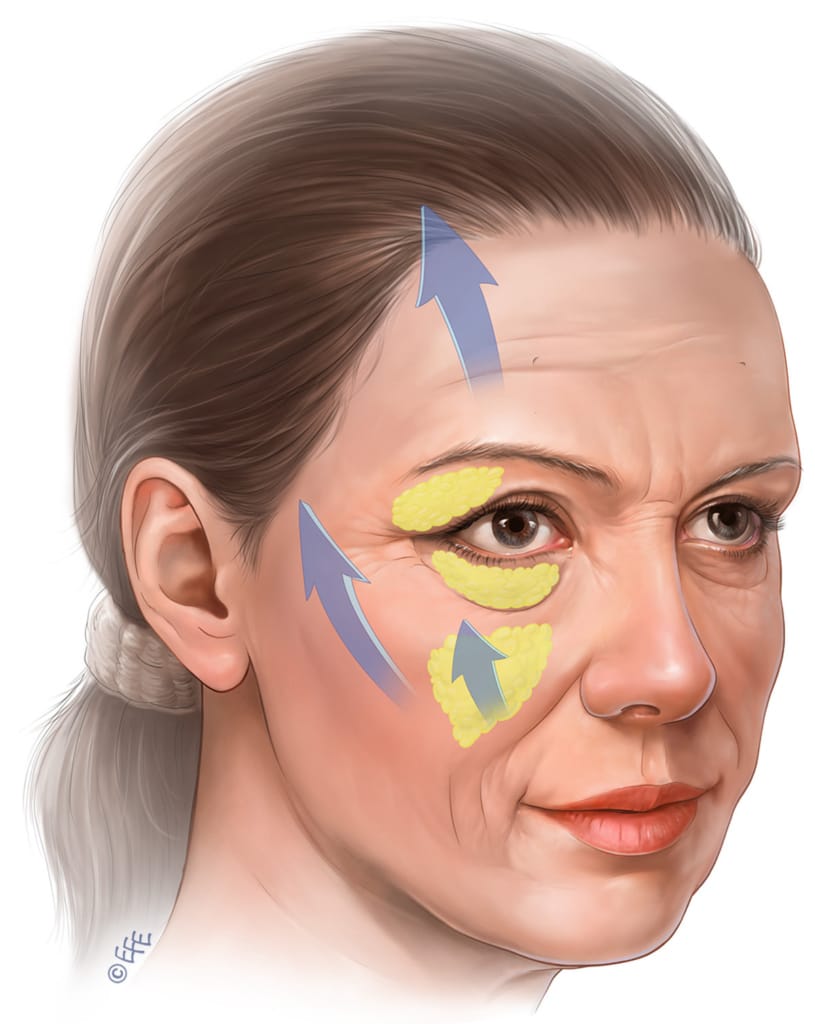 Endoscopic Face Lift Surgery