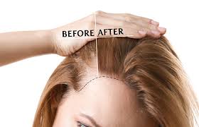 Hair Mesotherapy