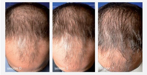 How Hair Mesotherapy Works
