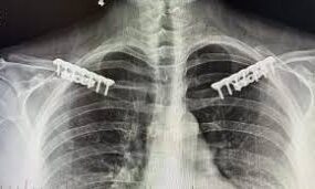 Transform Your Look with Clavicle Reduction Surgery in Turkey 2025 1 What is Clavicle Reduction Surgery