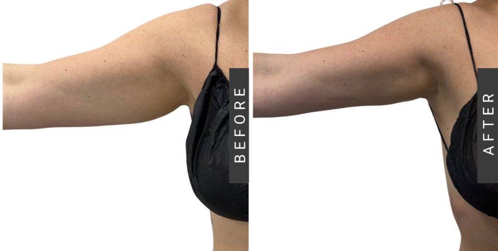 Arm Liposuction before and after