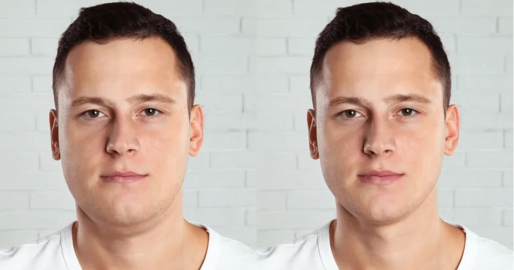before & after chin Neck Liposuction Results