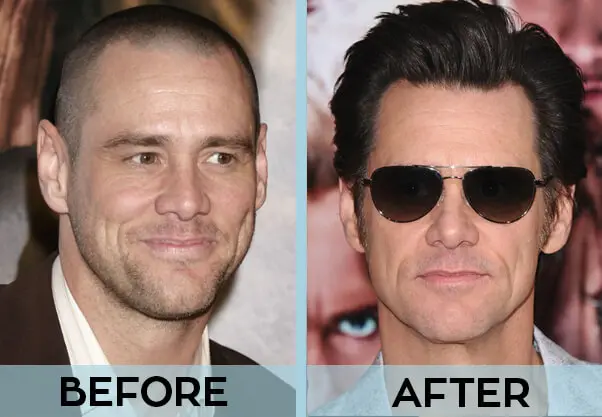 Celebrities Hair Transplant Before and After