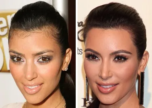 Celebrities Hair Transplant Before and After
