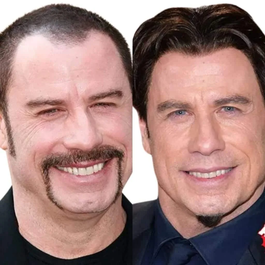 What Type of Hair Transplant Do Celebrities Get