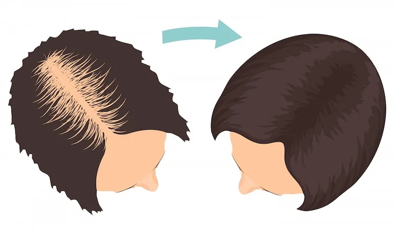 Female hair transplant Turkey