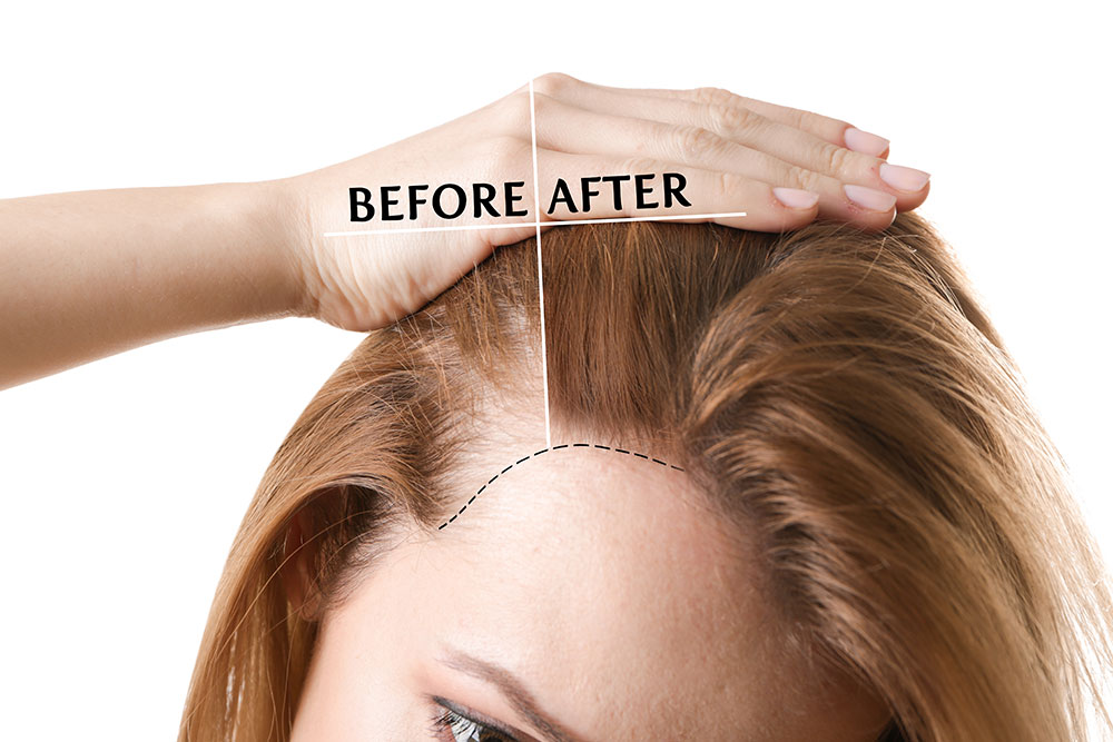 Female hair transplant before and after