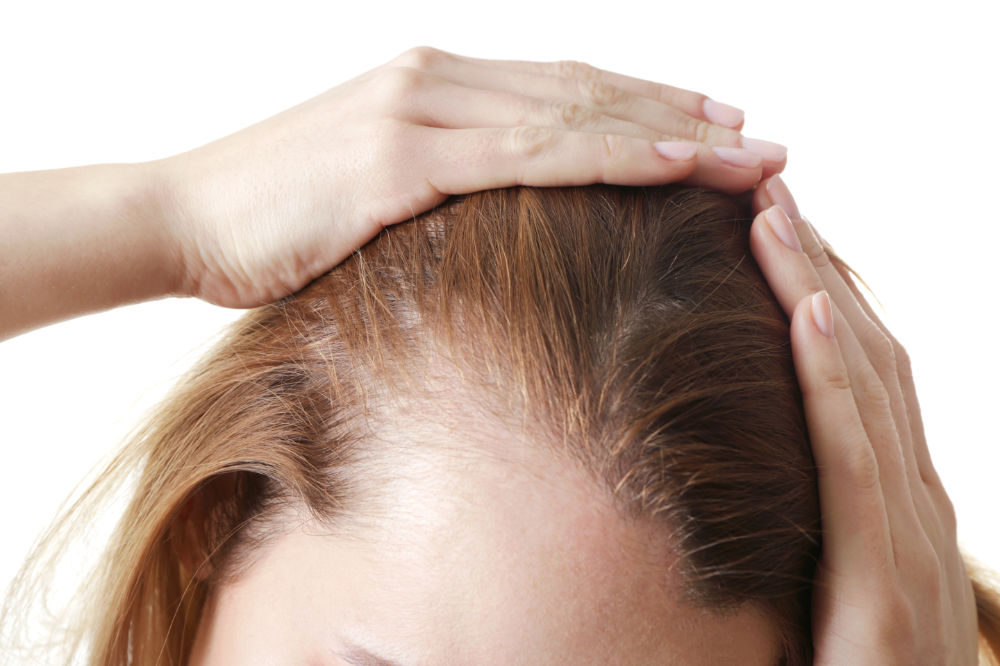 Female hair transplant