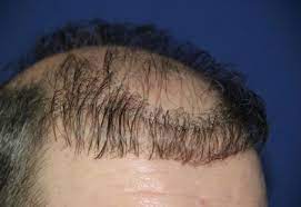 Hair Transplant Negative Effects