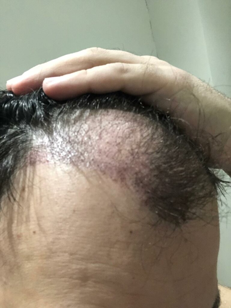 Hair Transplant Side Effects