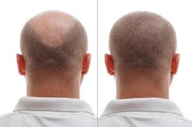 Hair Transplant before & after