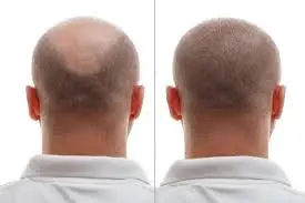 Hair Transplant before & after
