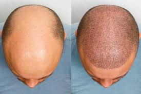 Hair Transplant in Esenyurt Istanbul