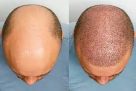 Hair Transplant in Esenyurt: The Ultimate Guide to Hair Restoration in Istanbul’s Growing District 213 Hair Transplant in Esenyurt Istanbul