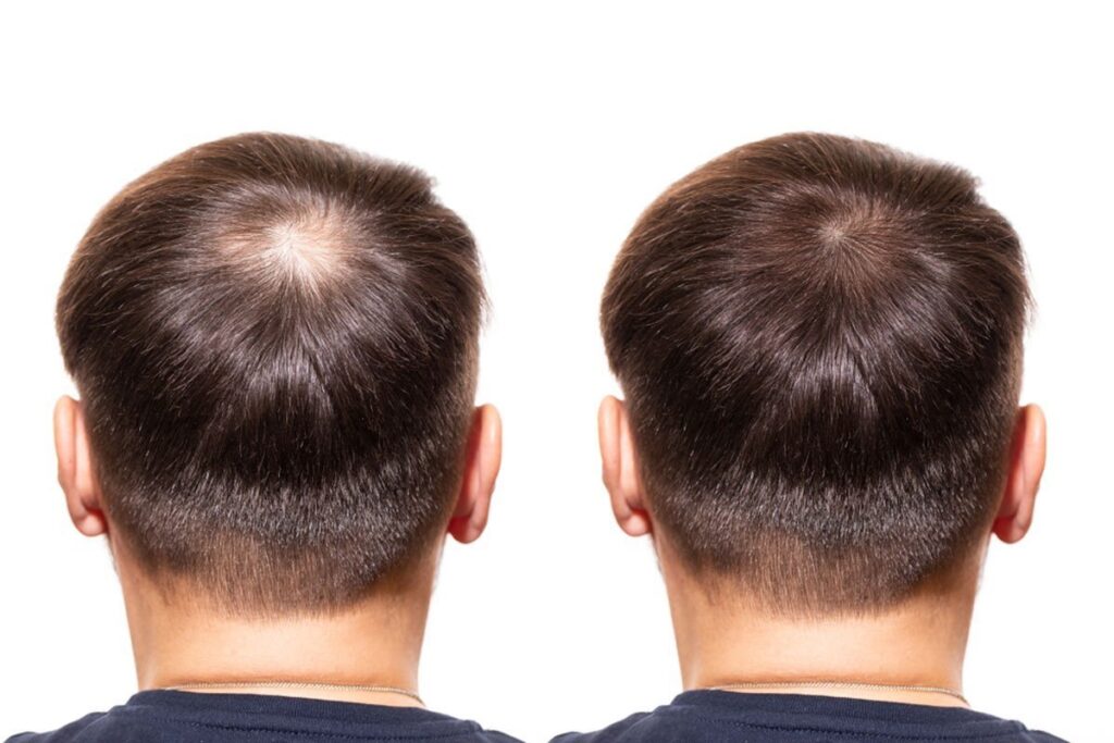Hair Transplantatıon before & after