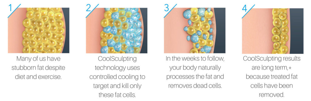 How Does Cryolipolysis Work