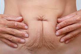 Scars and Physical Changes After Weight Loss Surgery: What to Expect & How to Treat Them 1 Loose Skin Afte Weight Loss