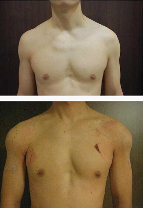 Men Shoulder Reduction Surgery Complications before and after