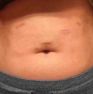 Scars and Physical Changes After Weight Loss Surgery: What to Expect & How to Treat Them 3 Scars After Weight Loss