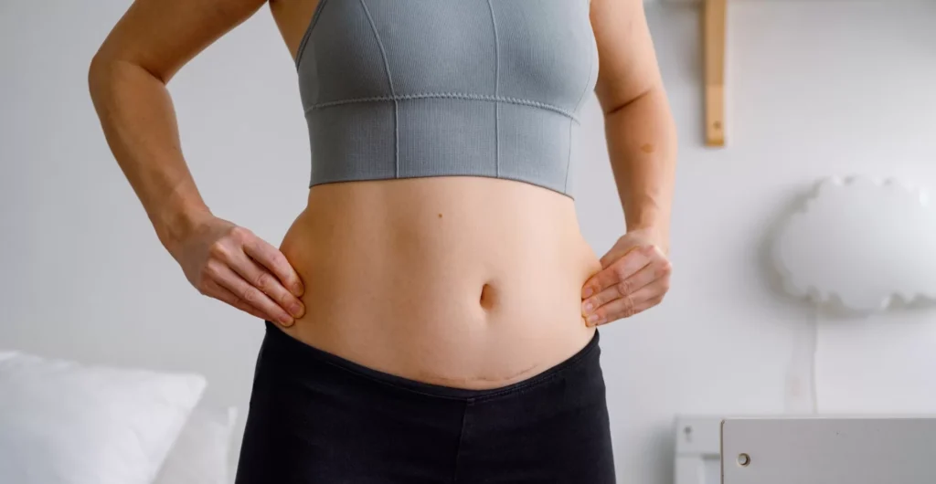 Scars and Physical Changes After Weight Loss Surgery: What to Expect & How to Treat Them 11 Scars and Physical Changes After Weight Loss Surgery