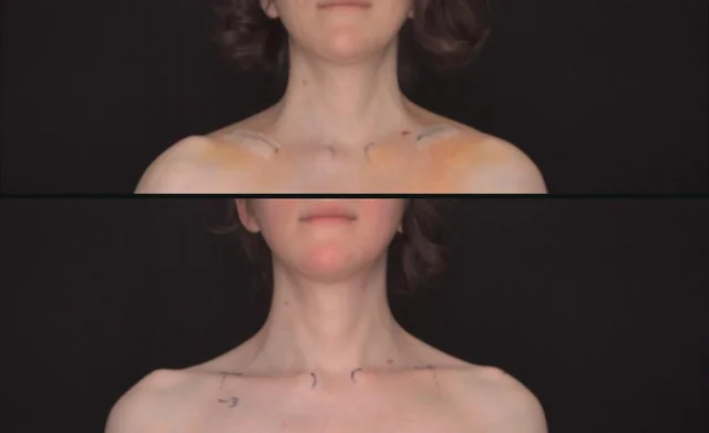 Shoulder Reduction Surgery Complications before and after