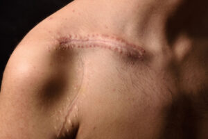 Shoulder Reduction Surgery
