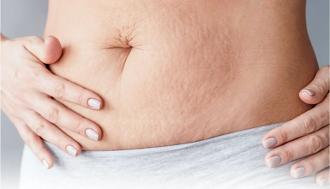 Scars and Physical Changes After Weight Loss Surgery: What to Expect & How to Treat Them 2 Stretch Marks and Sagging