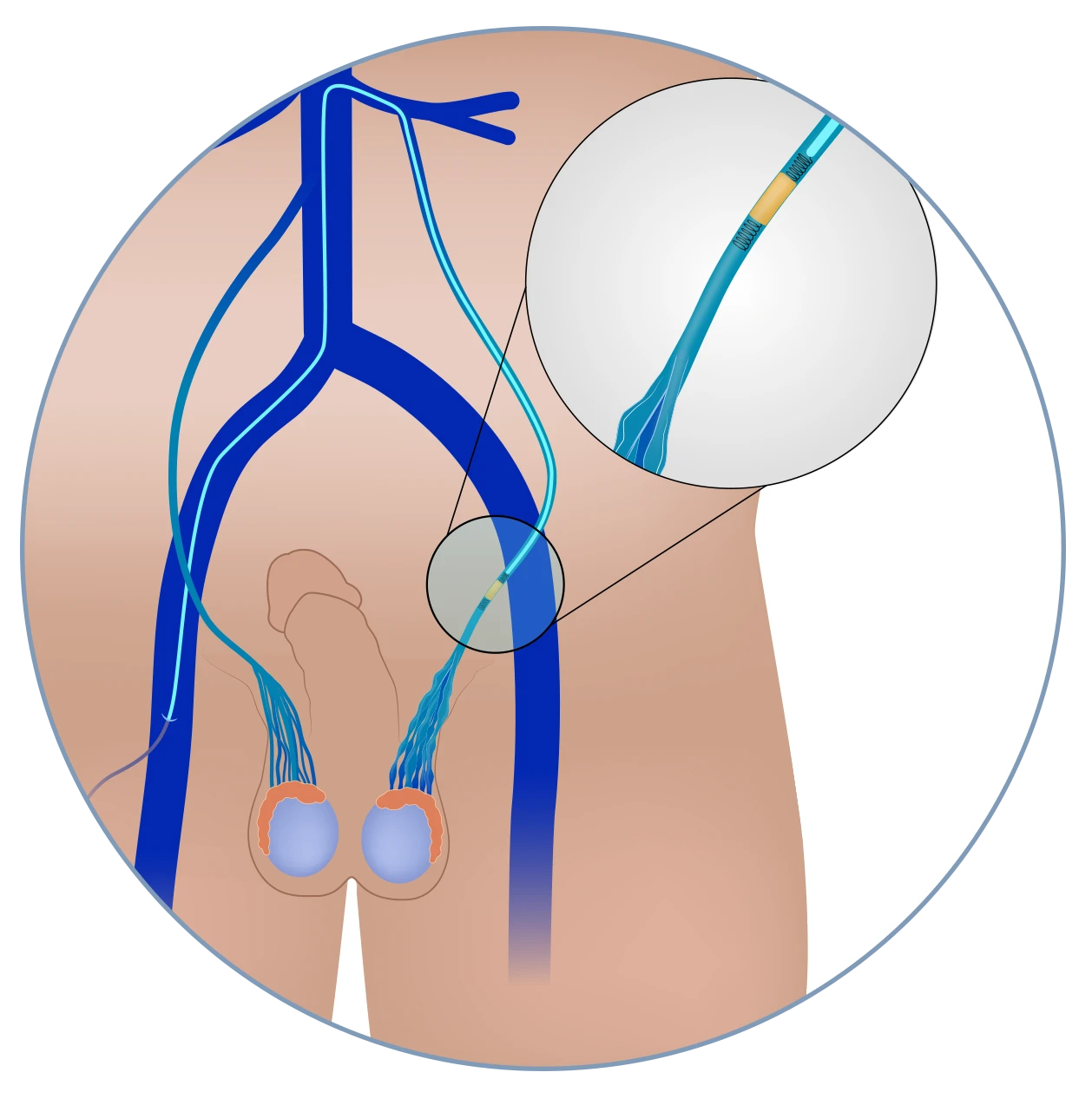 Varicocele Embolization