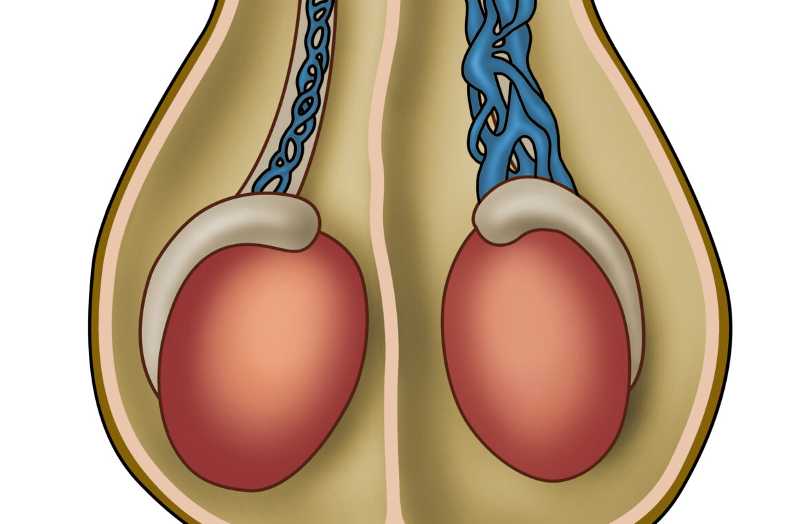 Varicocele Microsurgery Recovery Time