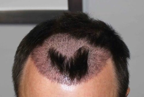 What Are the Negative Effects of Hair Transplant in Turkey
