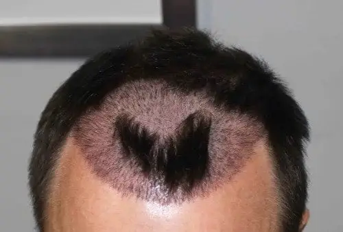 What Are the Negative Effects of Hair Transplant in Turkey? 210 What Are the Negative Effects of Hair Transplant in Turkey