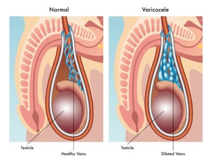 What is Varicocele Microsurgery