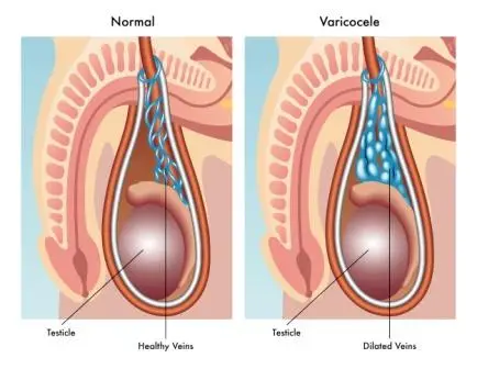 Varicocele Microsurgery Recovery Time: What You Need to Know 1 What is Varicocele Microsurgery