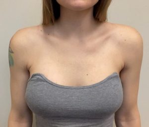 female shoulder reduction surgery