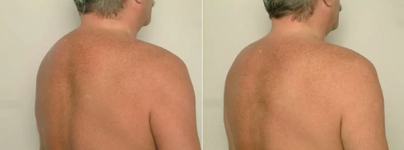 Buffalo Hump Liposuction before & after