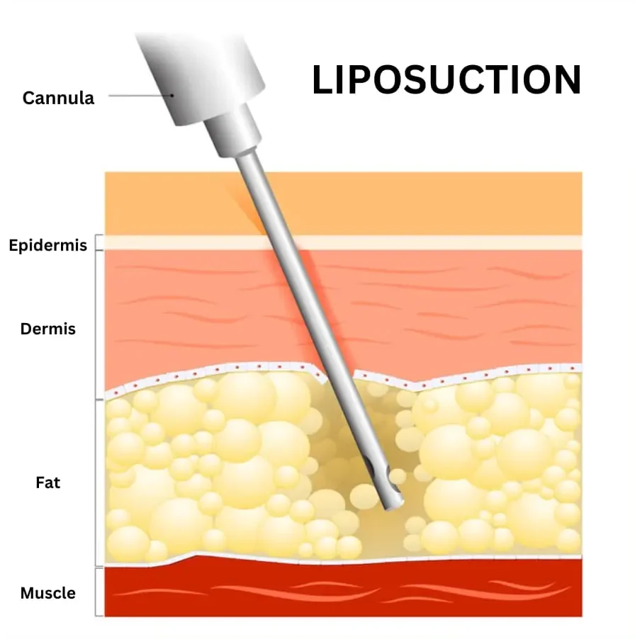 Buffalo Hump Liposuction procedure