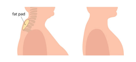 What is Buffalo Hump Liposuction