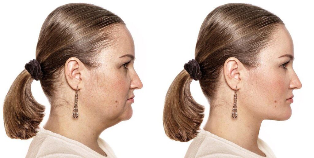 before & after chin Neck Liposuction Results