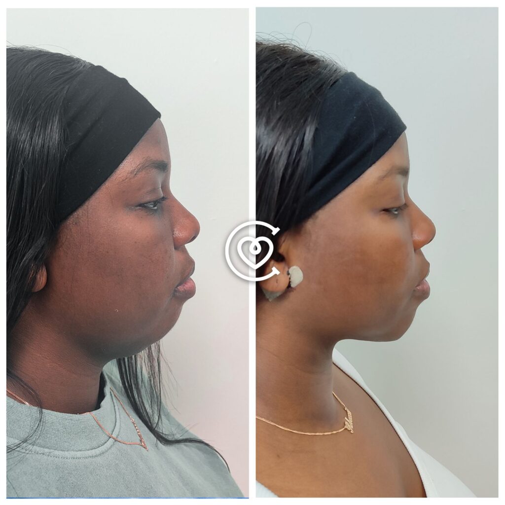 before and after chin Neck Liposuction Results