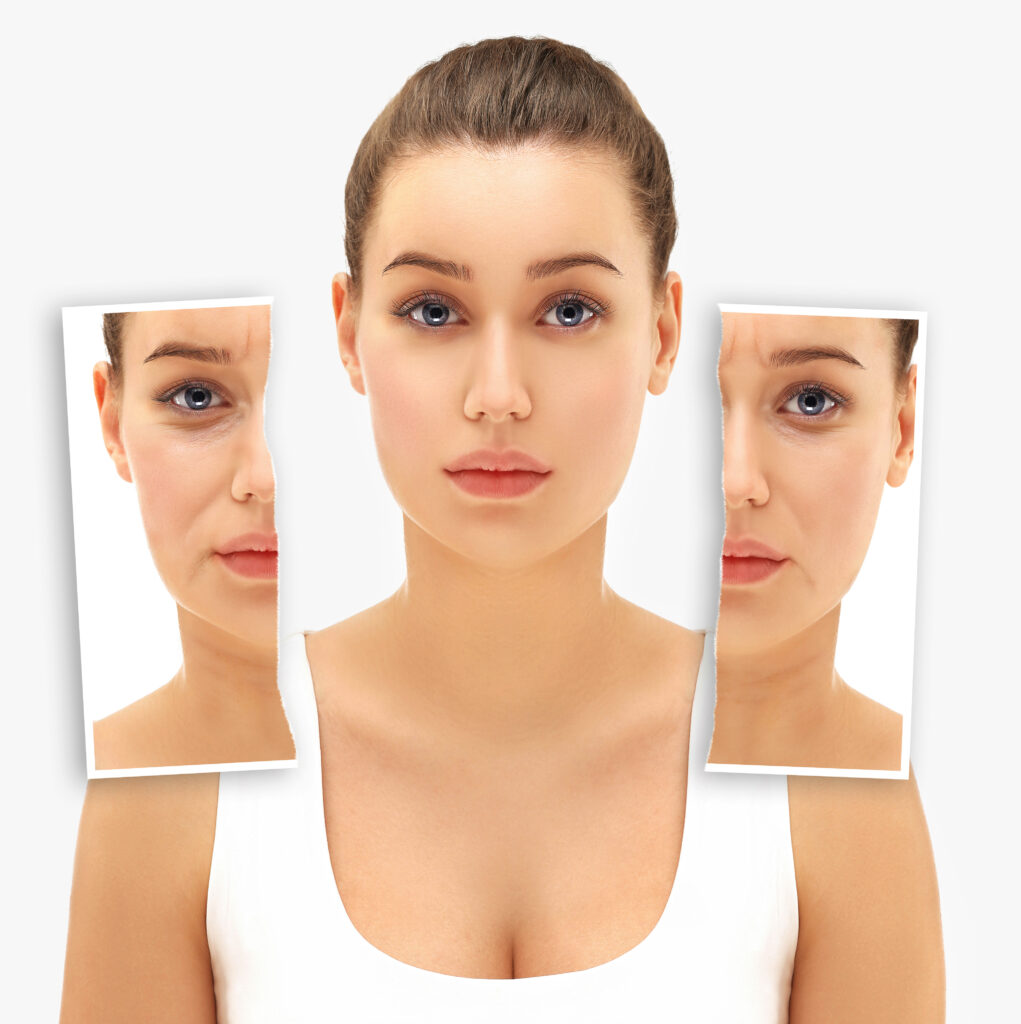 Botox Result