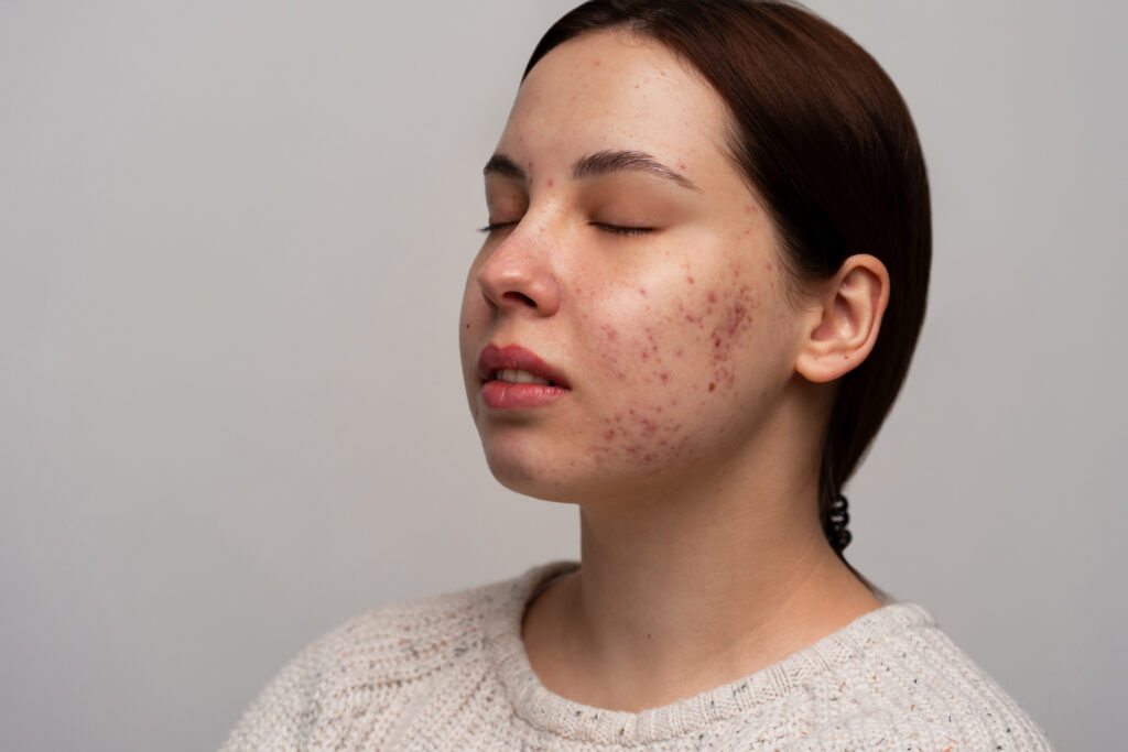Laser Acne Scar Treatment