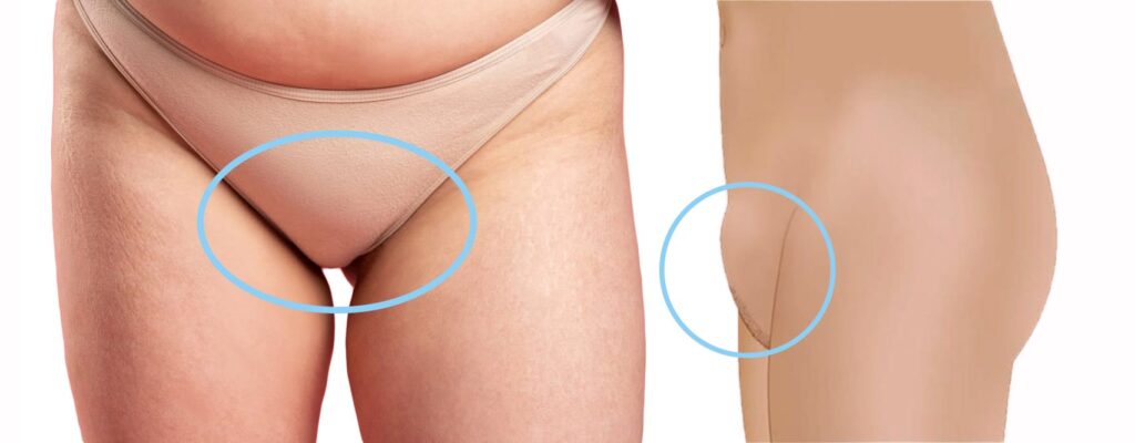 FUPA Surgery in Turkey 2025 – Fat Upper Pelvic Area Liposuction & Lifting at Cayra Clinic 2 What ıs FUPA Surgery
