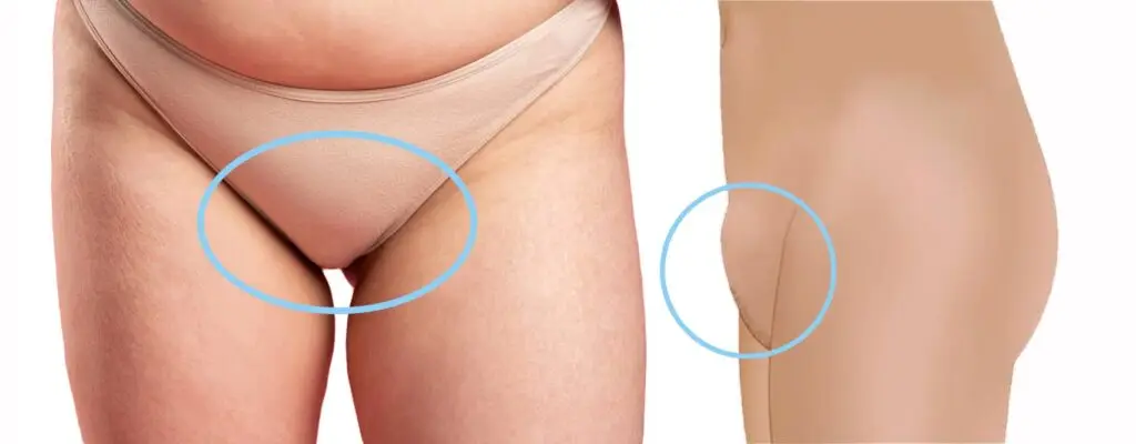 FUPA Surgery in Turkey 2026 – Fat Upper Pelvic Area Liposuction & Lifting at Cayra Clinic 106 FUPA Surgery