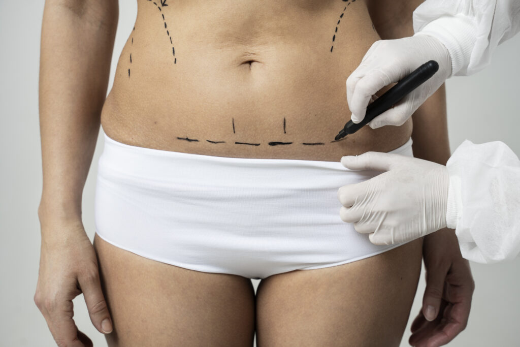 FUPA Surgery in Turkey 2025