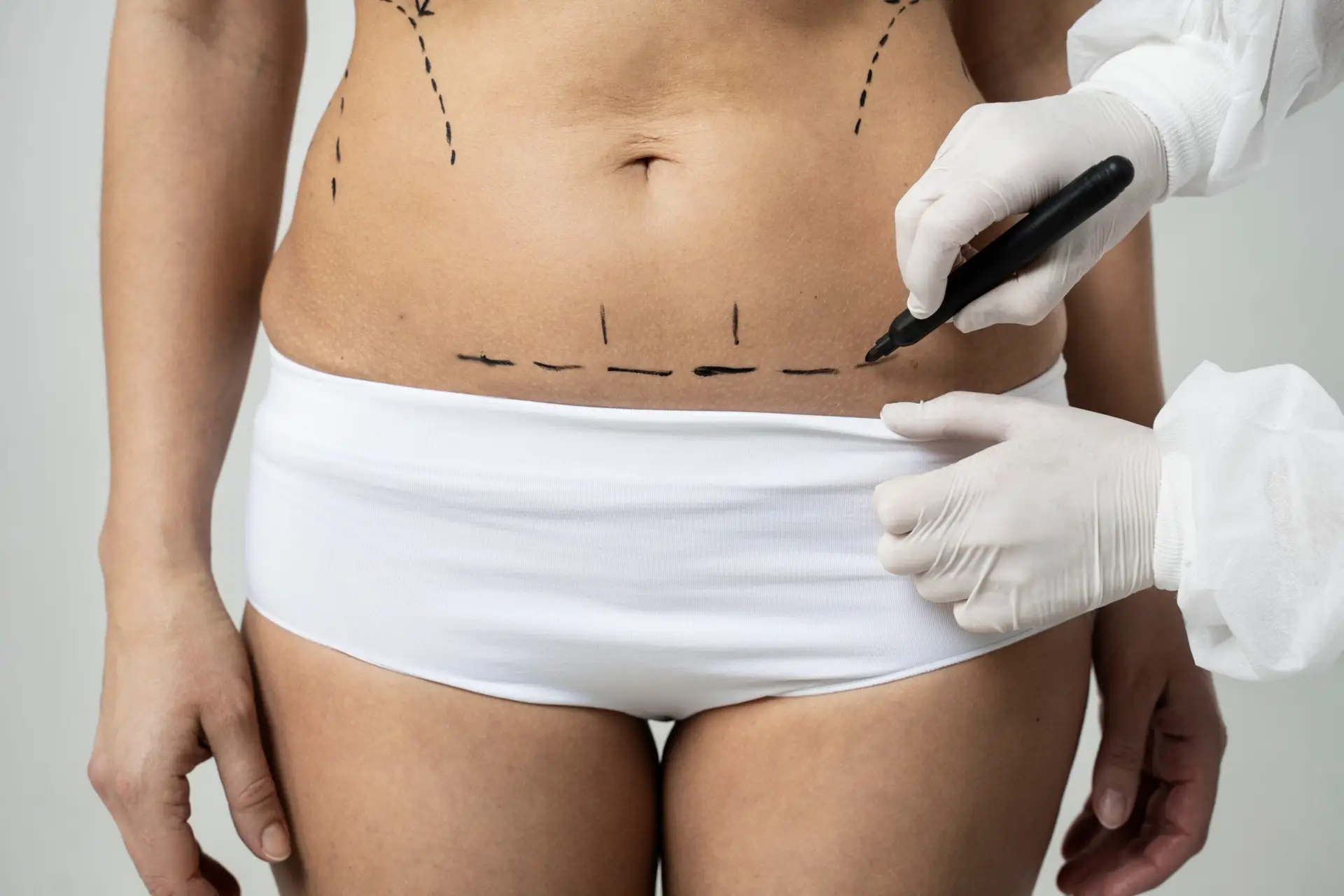FUPA Surgery in Turkey 2025