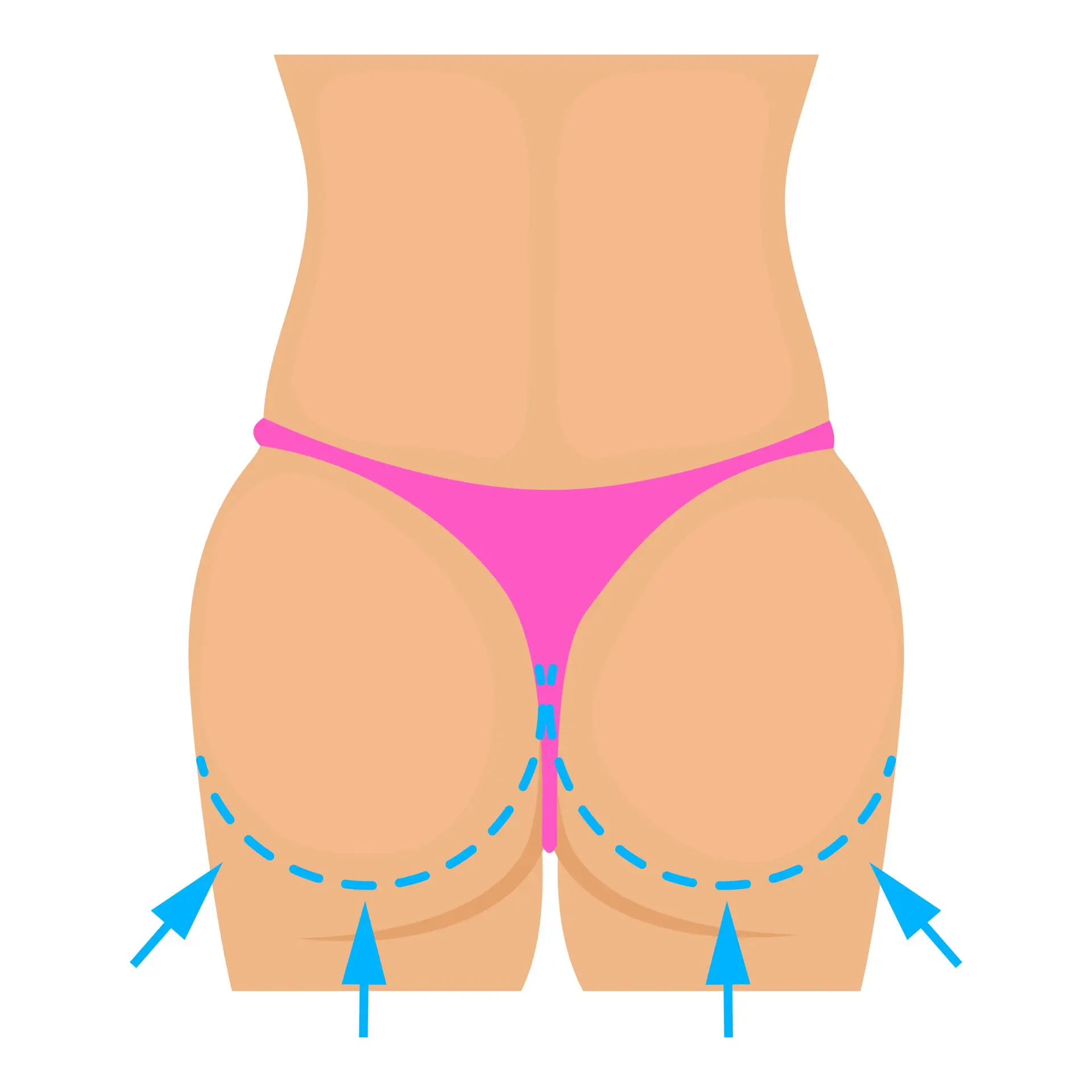Risks of Buttock Implants