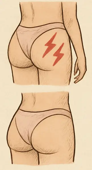 Common Sıde Effects Of Buttock Implants