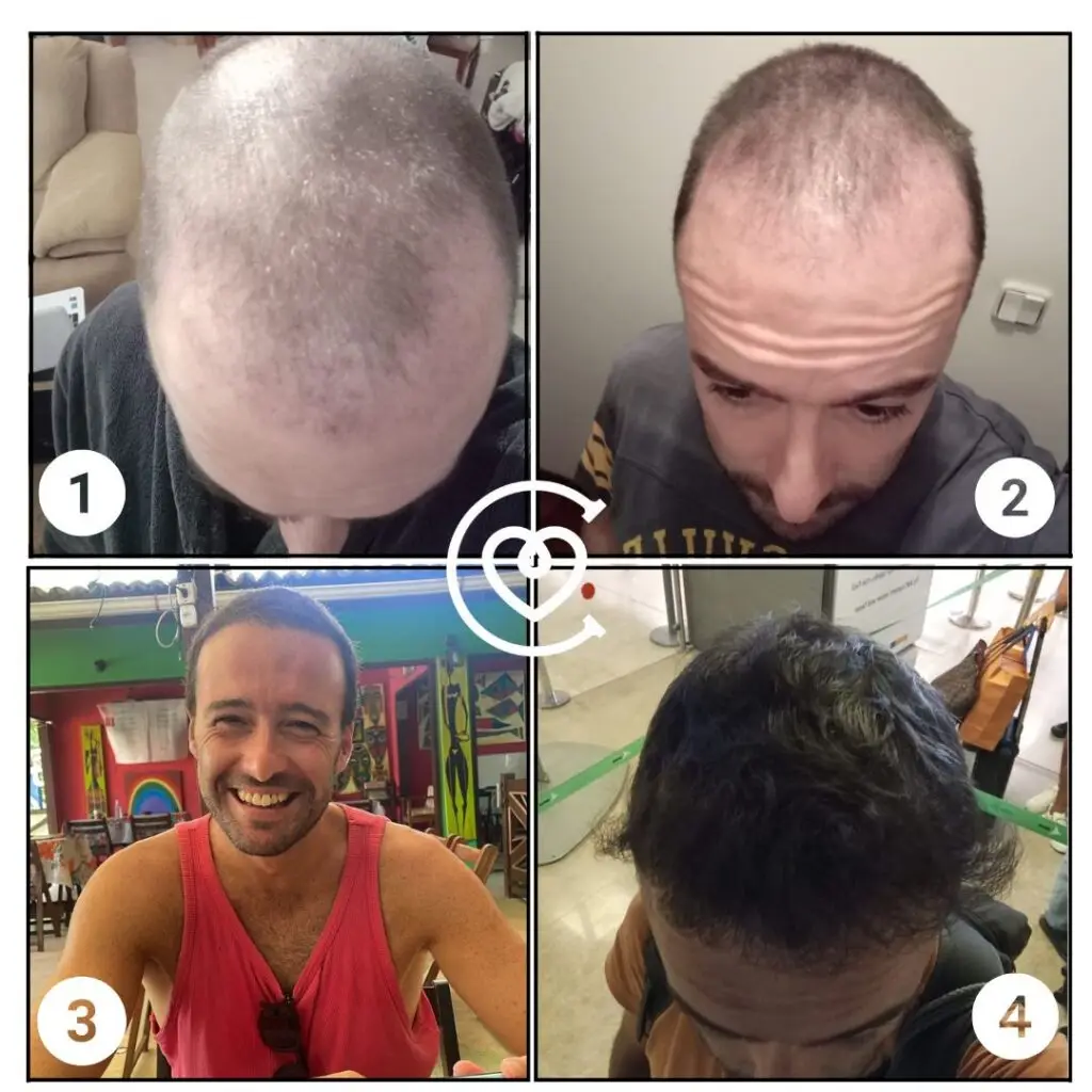 DHI Hair Transplant 3 Hair transplant progress