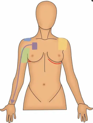 Mastectomy Treatment