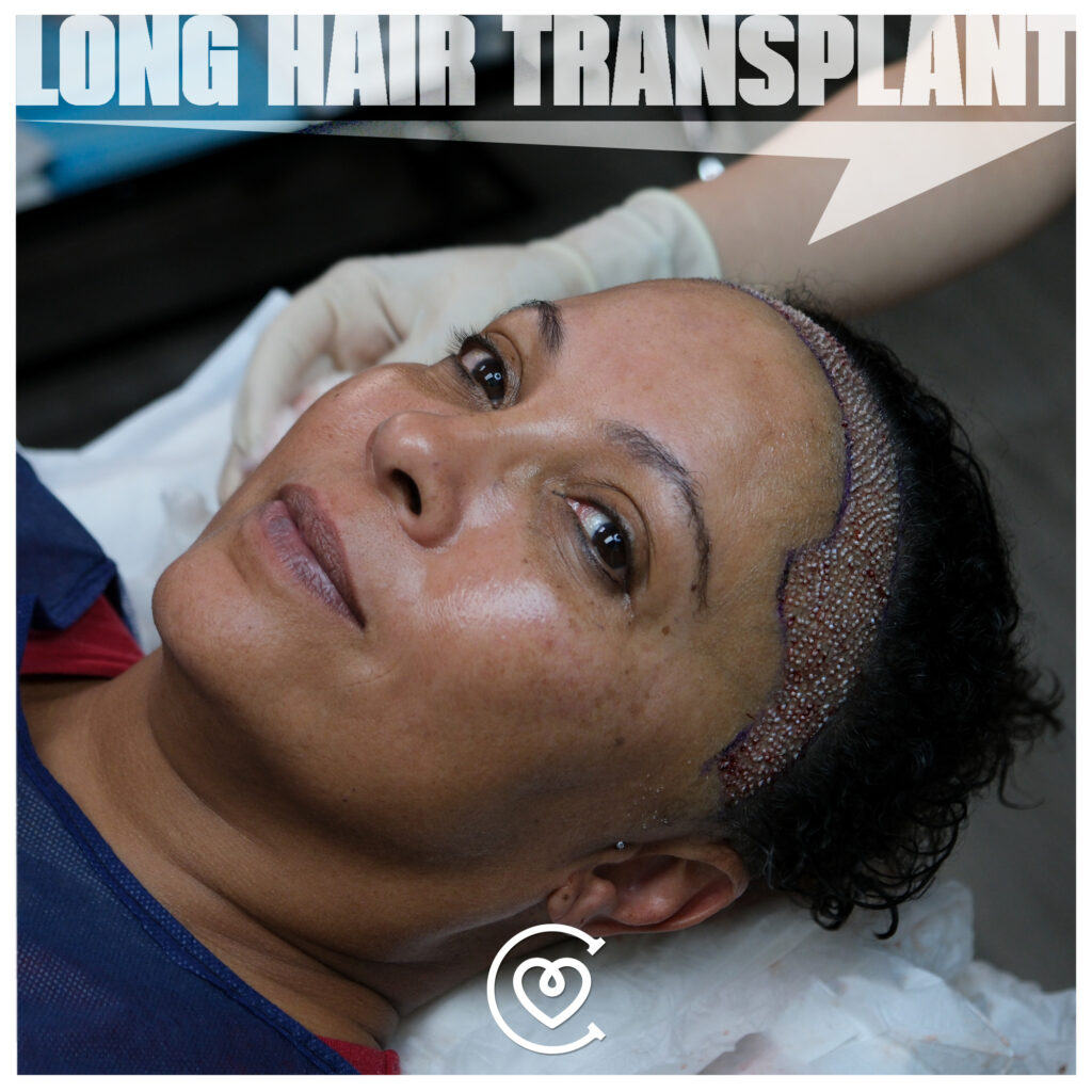 DHI Hair Transplant 5 caa